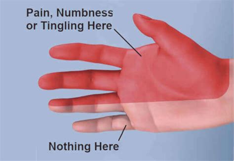 What helps carpal tunnel pain while sleeping?