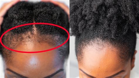 What helps edges grow back?