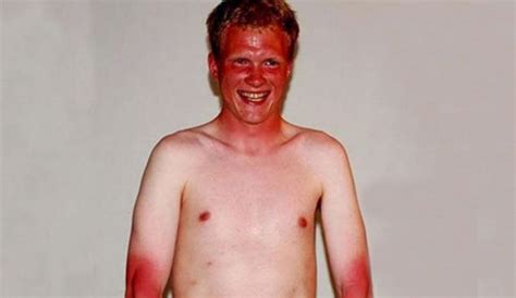 What hours are worst for sunburn?
