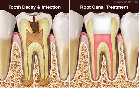 What if I never got a crown on my root canal?