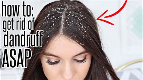 What if I still have dandruff after washing my hair?
