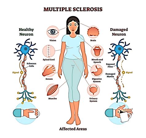 What impact does multiple sclerosis have on society?