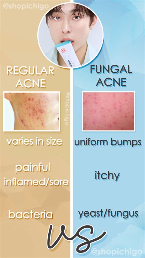 What ingredients cause fungal acne?