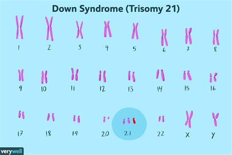 What is 21 chromosome disease?