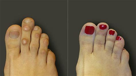 What is Cinderella foot surgery?