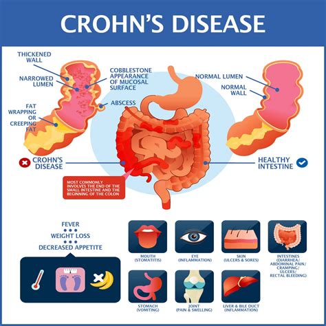 What is Crohn's belly?