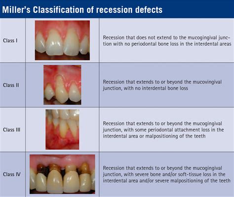 What is Grade 3 gum recession?