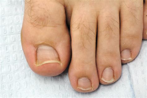 What is Morton's toe?