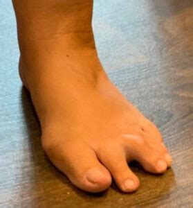 What is Morton's toe associated with?