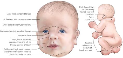 What is Noonan syndrome?