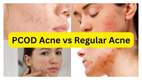 What is PCOS acne?