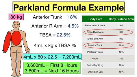 What is Parkland formula 50%?
