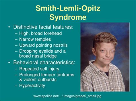 What is Smith Lemli Opitz syndrome?