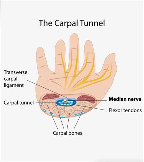What is Stage 1 carpal tunnel syndrome?
