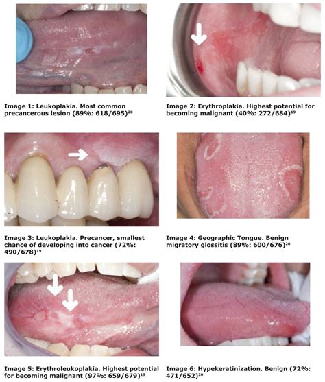 What is Stage 1 oral cancer?