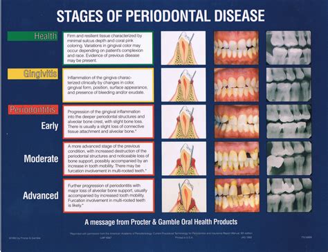 What is Stage 3 Grade C periodontitis?