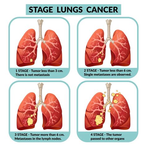 What is Stage 4 lung adenocarcinoma?