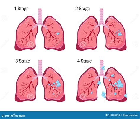 What is Stage 4 lung disease?