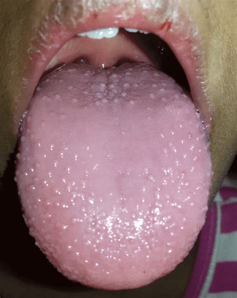 What is Strawberry tongue?