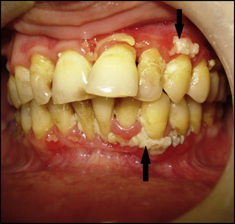 What is Trenchmouth?