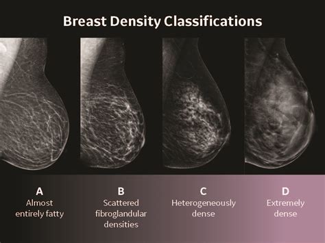 What is Type D breast density?