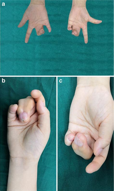 What is a 3 4 finger syndactyly?