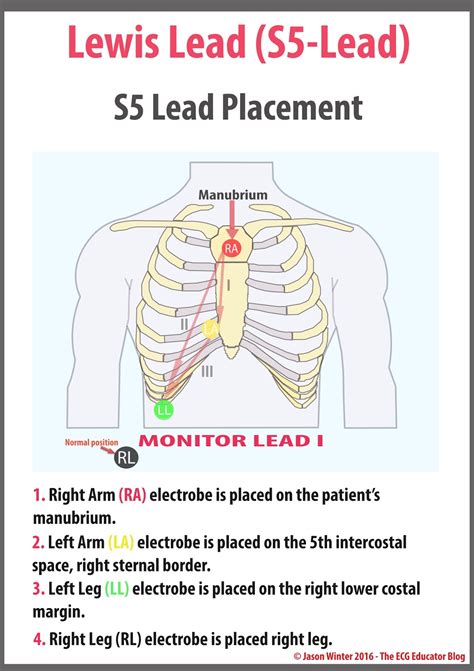 What is a 3 lead?