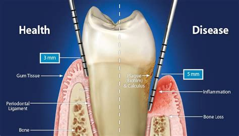 What is a 3mm pocket depth?