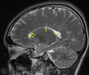 What is a Dawson's finger in multiple sclerosis?