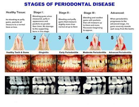 What is a Grade 3 periodontal disease?