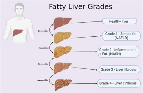 What is a Stage 3 fatty liver?