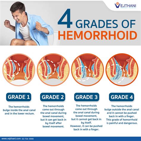 What is a Stage 4 hemorrhoid?