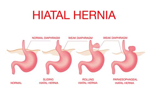 What is a Stage 4 hiatal hernia?