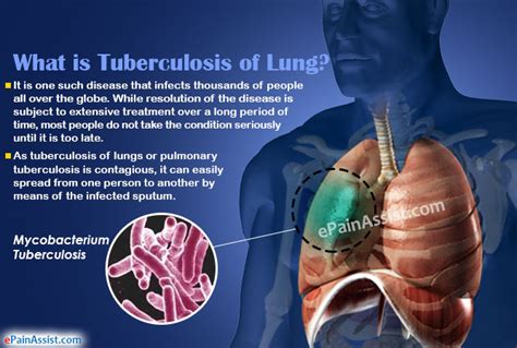 What is a TB?