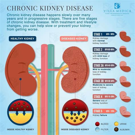 What is a bad number for kidney failure?