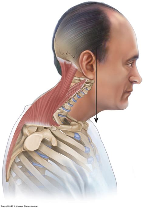 What is a bent neck syndrome?
