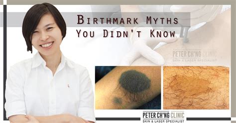 What is a birthmark myth?