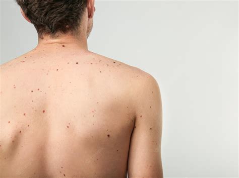 What is a birthmark that doesn't go away?