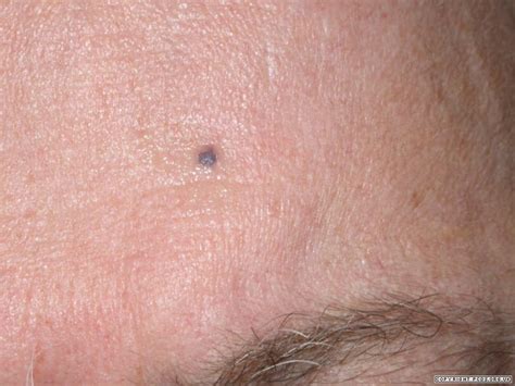 What is a blue spot on the skin of an adult?