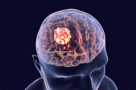 What is a brain tumor phantosmia?