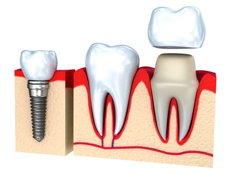 What is a cap in dental work?