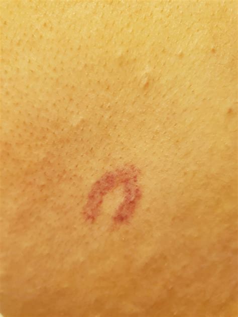 What is a diamond shaped mark on skin?