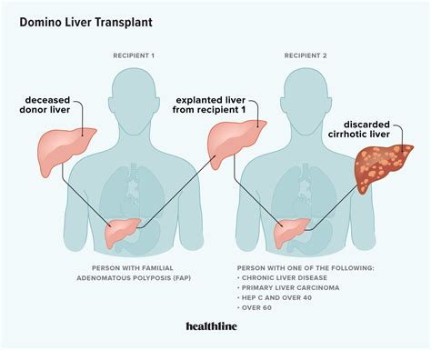 What is a domino transplant?