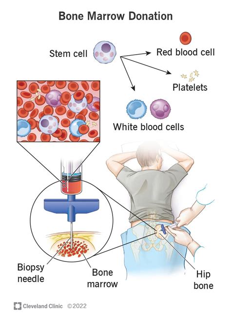 What is a donor bone called?