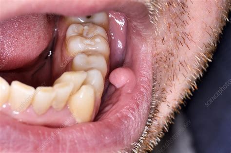 What is a fibroma in the mouth?