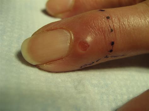 What is a finger infection from STD?