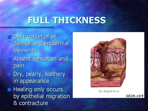 What is a full thickness burn?