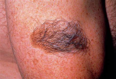 What is a hairy birthmark?