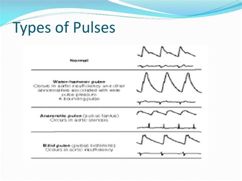 What is a hammer pulse?