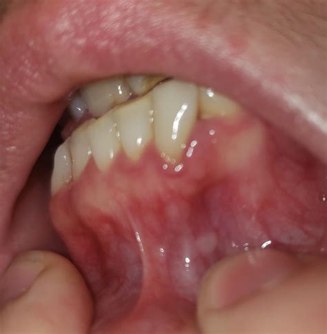 What is a hard bony bump on my gums painless?